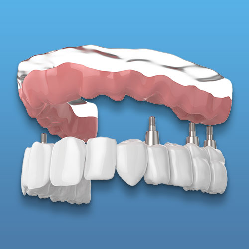 tooth implant procedure