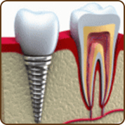Fate Implant Dentistry